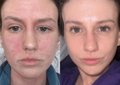 Skin Texture & Tone Results