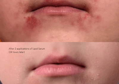 Dermatitis Relief