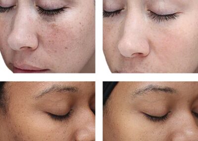 VI Peel before and after Canton GA