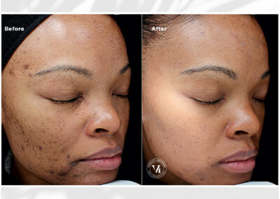 VI Peel before and after Canton GA