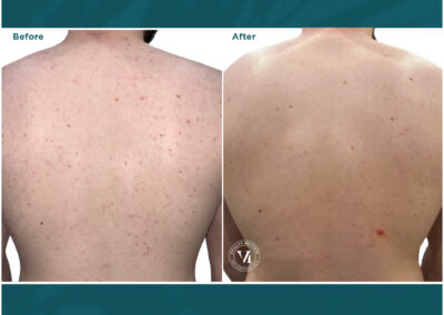 VI Peel before and after Canton GA