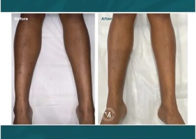 VI Peel before and after Canton GA